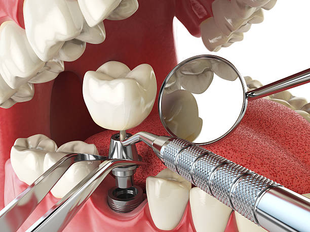 Best Emergency Tooth Extraction in Sioux Center, IA